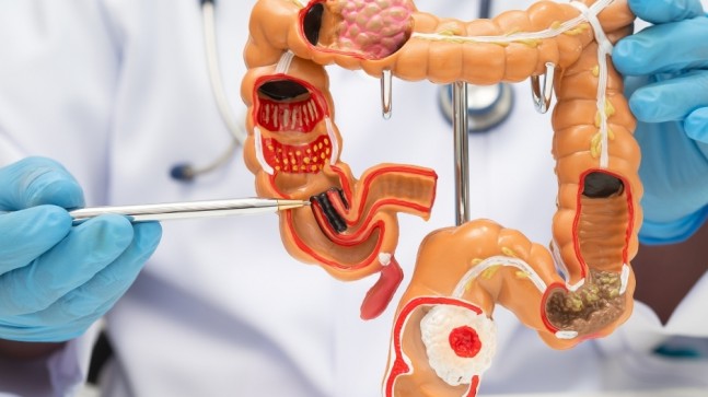 Kolorektal Kanser Farkındalığı 